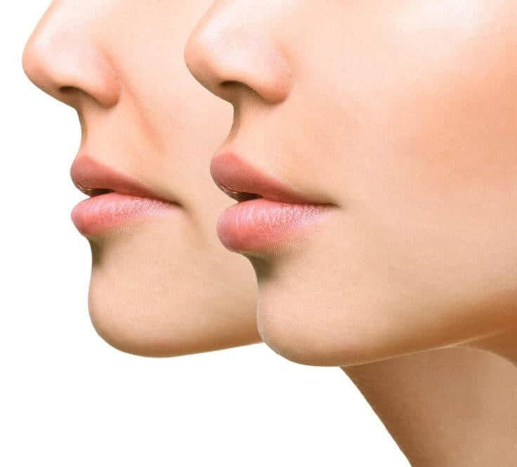 BANNER lip injections lip augmentation 1