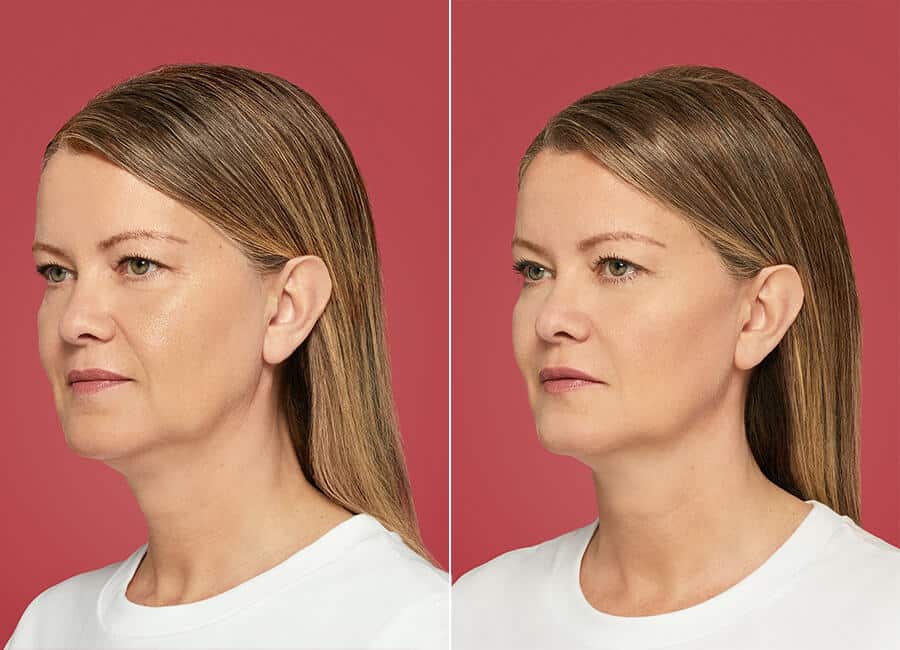before and after contour 1