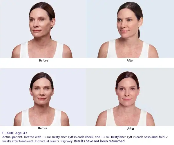 facial balancing before and after restylane 1